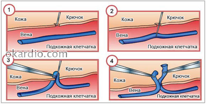 Флебэктомия