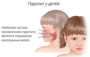 Формы свинки