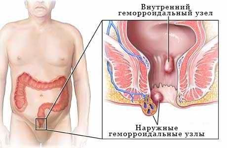 Расположение геморроидальных узлов Расположение геморроидальных узлов