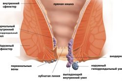 Схема геморроя Схема геморроя