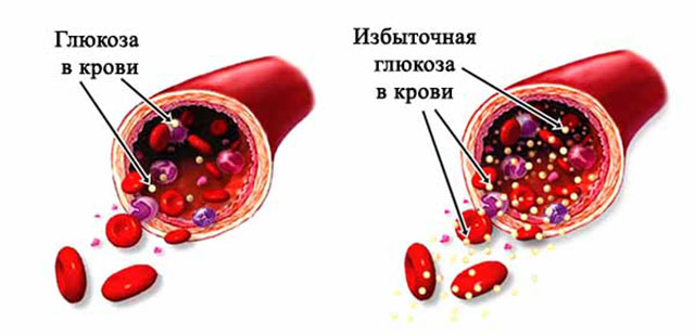 Избыточная глюкоза в крови