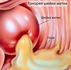 Гнойные выделения из влагалища
