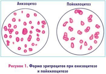 Форма эритроцитов при анизоцитозе и пойкилоцитозе