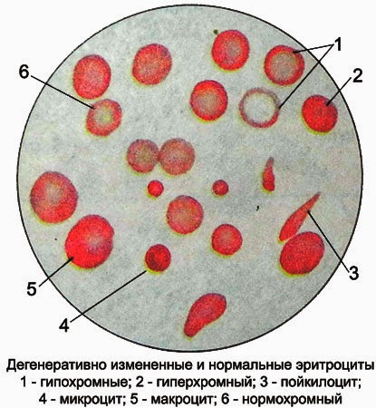 Изменённые и нормальные эритроциты