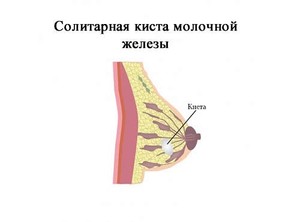Киста в груди у женщин