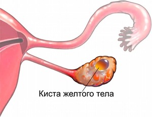 Киста желтого тела левого яичника Киста тела левого яичника