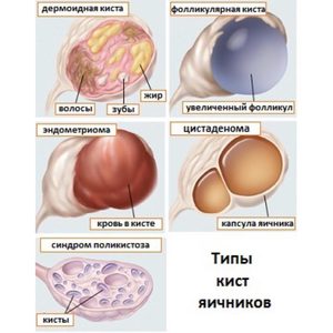 Киста желтого тела левого яичника - причины, симптомы и лечение Киста желтого тела левого яичника - причины