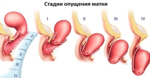 Классификация заболевания опущения матки