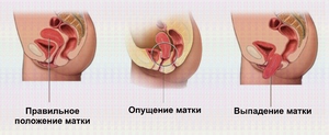 Консервативная терапия опущения матки