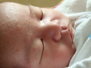 От чего красные и белые прыщики на лице у новорожденного От чего красные и белые прыщики на лице