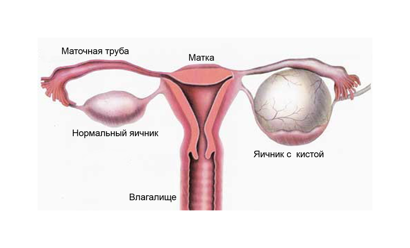 Лечение кисты на яичнике