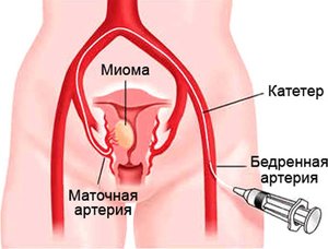 Лечение миомы матки без операции