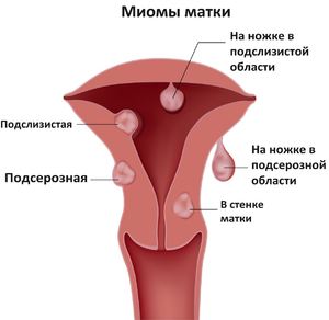 Лечение миомы матки лекарственными препаратами