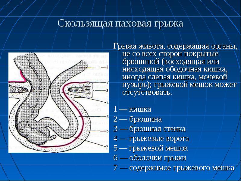 Лечение паховой грыжи у женщин