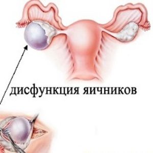 Как лечить кисту яичника без операции