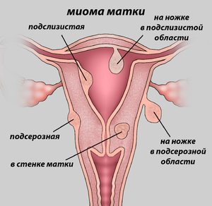 Чем лечить миому матки