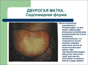 Виды патологии строения матки Как лечить патологию