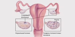 Как лечить поликистоз яичников