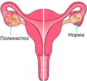Как лечить поликистоз яичников