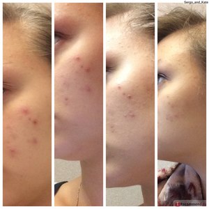 Косметические средства от прыщей Как лечить прыщи