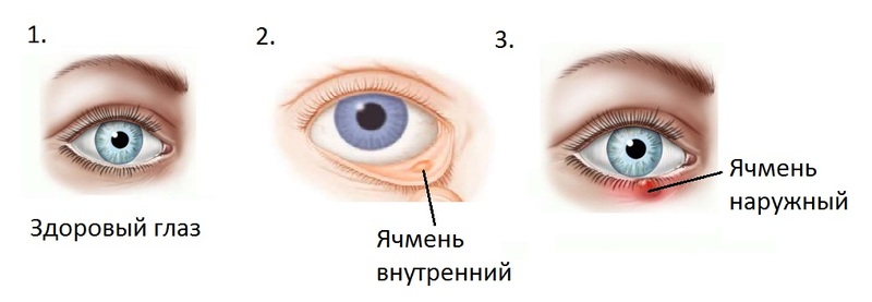 Как лечить ячмень в домашних условиях