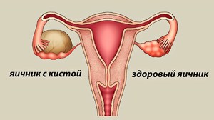 Лютеиновая киста правого яичника