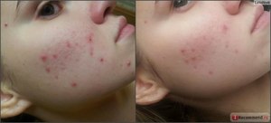 Как убрать следы от прыщей Масло убирает следы от прыщей.
