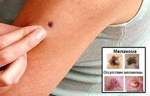 Меланома на коже