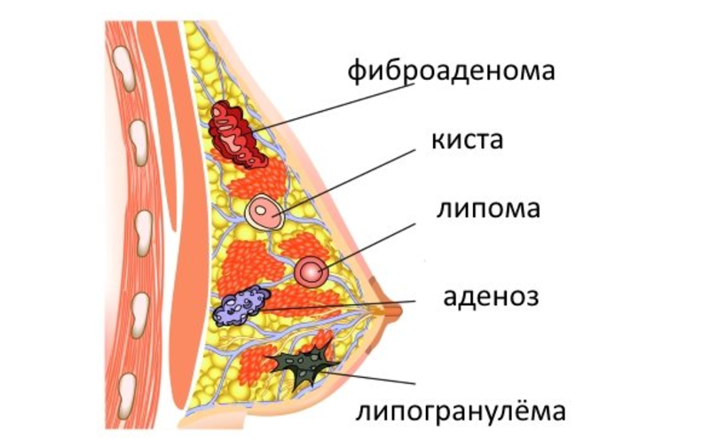 Методы лечения новообразований