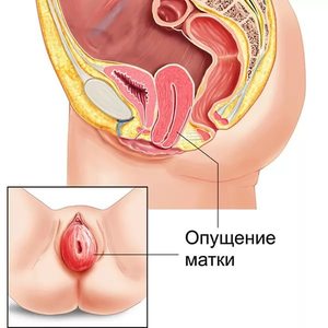 Методы лечения опущения матки