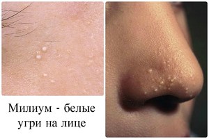 Милиумы (белые угри) - как убрать белые точки Милиумы (белые угри)