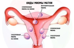Миома матки при беременности