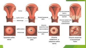 Народный способ лечения патологии