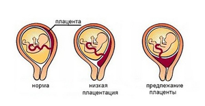 Низкое предлежание плода Низкое предлежание