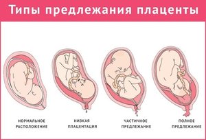 Низкое предлежание планценты Низкое предлежание