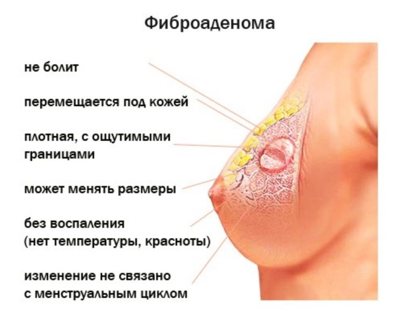 Очаговая форма аденоза