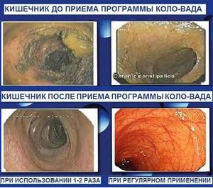 Чистка кишечника организма от шлаков и токсинов: Как очистить организм от токсинов таблетки Как очистить организм от токсинов таблетки
