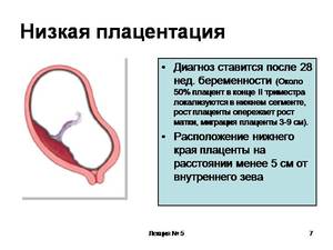 Чем опасна низкая плацентация Чем опасна низкая плацентация для беременных