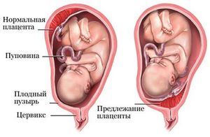 Предлежание хориона: описание и виды Описание разновидностей предлежания хориона