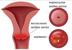 Основные способы лечения эрозии
