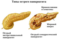 Типы острого панкреатита Типы острого панкреатита