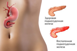 Схема панкреатита Схема панкреатита