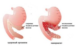 Схема панкреатита Схема панкреатита
