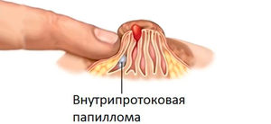 Папиллома молочной железы: причины и лечение