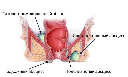 Парапроктит - осложнение геморроя Парапроктит - осложнение геморроя