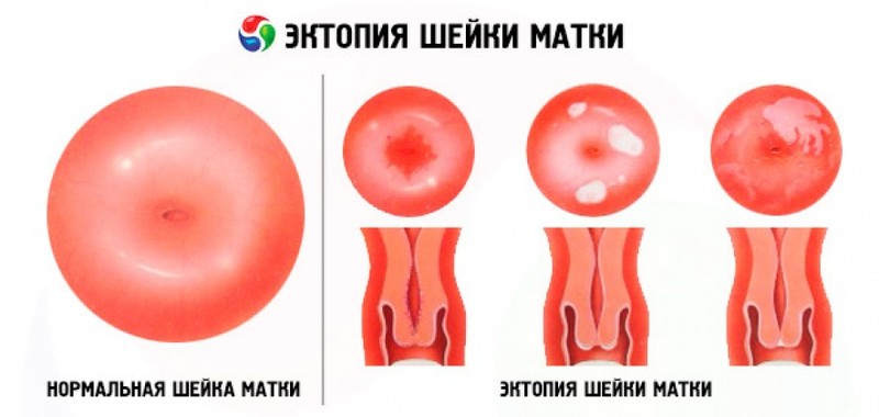Патология шейки матки