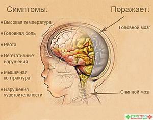 Первые признаки менингита