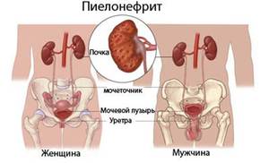 Причины развития пиелонефрита у детей Пиелонефрит: причины развития