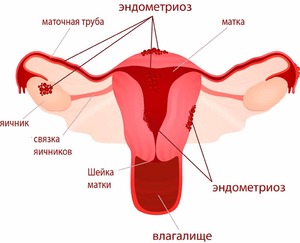 Почему появляются коричневые выделения перед месячными
