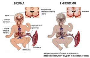 Причины и последствия гипоксии плода Последствия гипоксии плода